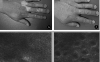 白驳风治疗新技术 负压吸疱法表皮移植治疗白癜风过程，稳定期白癜风，无色素痣