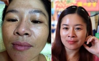 雨婷生物科技 网购化妆品 使用之后毁容